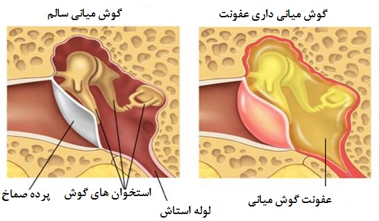 عفونت گوش میانی در اطفال